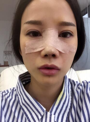 隆鼻整形真實(shí)恢經(jīng)歷 曬圖啦！