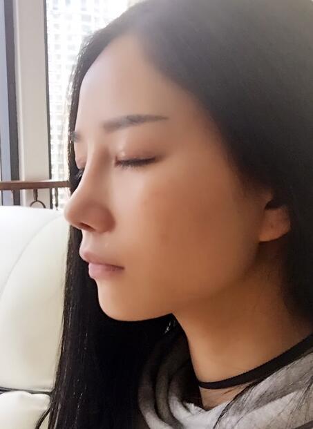 隆鼻整形真實(shí)恢經(jīng)歷 曬圖啦！