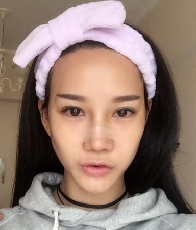 隆鼻整形真實(shí)恢經(jīng)歷 曬圖啦！