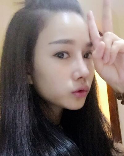 隆鼻整形真實(shí)恢經(jīng)歷 曬圖啦！