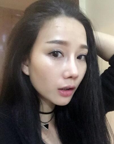 隆鼻整形真實(shí)恢經(jīng)歷 曬圖啦！