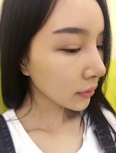 鼻修復后的恢復期經(jīng)歷分享