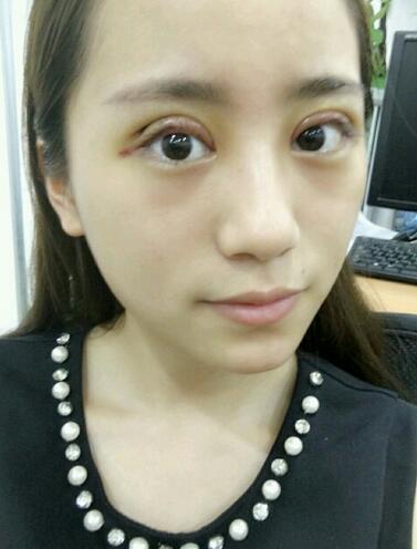 割雙眼皮案例圖片 雙眼皮手術(shù)20天