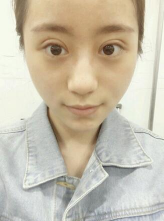 割雙眼皮案例圖片 雙眼皮手術(shù)20天