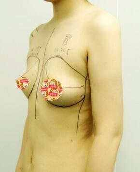 自體脂肪豐胸恢復(fù)正常需要多久 我的經(jīng)歷告訴你