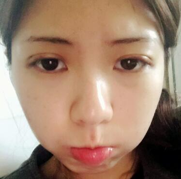 廣州凱美達(dá)微創(chuàng)雙眼皮手術(shù)恢復(fù)期紀(jì)實(shí)