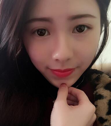 廣州凱美達(dá)微創(chuàng)雙眼皮手術(shù)恢復(fù)期紀(jì)實(shí)