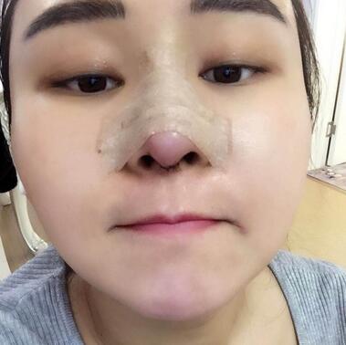 上海余天成二次鼻修復(fù)恢復(fù)日記 隆鼻整形修復(fù)+下巴吸脂