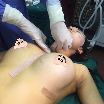 上海余天成自體脂肪隆胸70天恢復(fù)經(jīng)歷