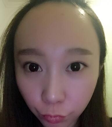 廣州倍生女性發(fā)際線調(diào)整案例