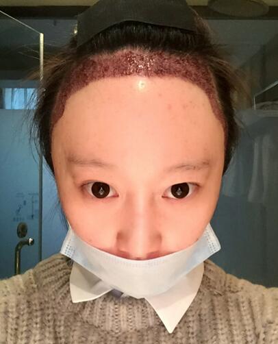 廣州倍生女性發(fā)際線調(diào)整案例