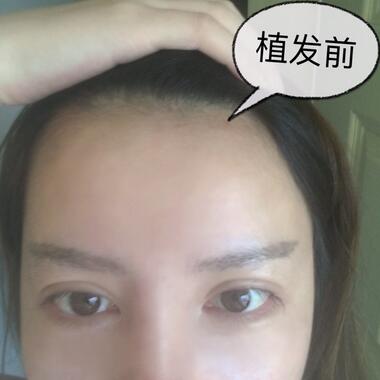 廣州倍生發(fā)際線種植前后對比照片