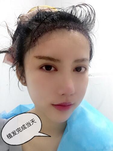 廣州倍生發(fā)際線種植前后對比照片