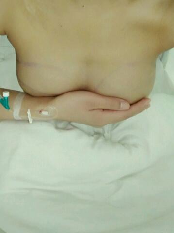 武漢茜韻自體脂肪豐胸后十五天圖