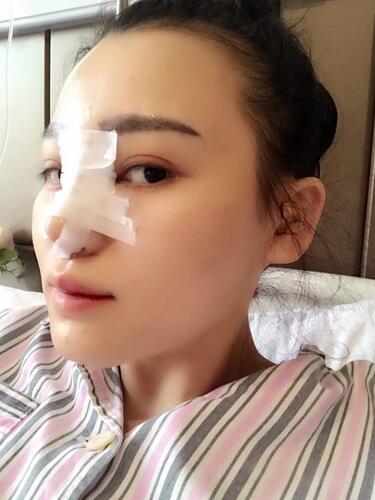 上海九院李圣利隆鼻整形真實(shí)恢復(fù)期圖片
