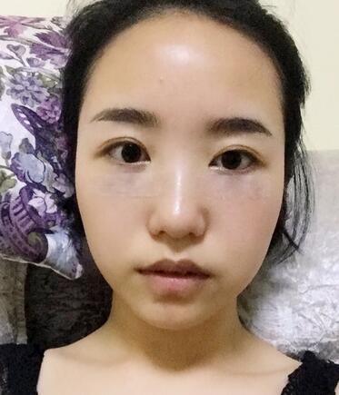 武漢憶美凱德去眼袋手術(shù)后兩個月照片