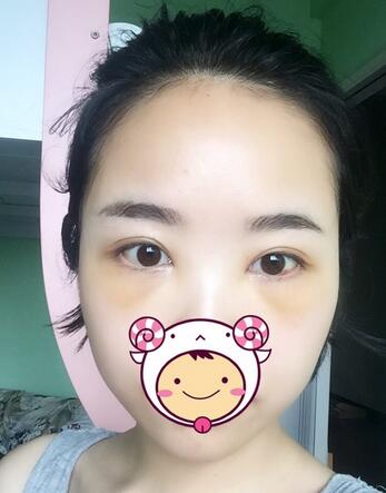 武漢憶美凱德去眼袋手術(shù)后兩個月照片