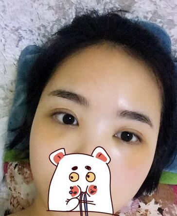 武漢憶美凱德去眼袋手術(shù)后兩個月照片