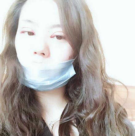 武漢樂美開眼角+雙眼皮3個月恢復圖片