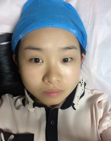 武漢樂美韓式微創(chuàng)雙眼皮+開內眼角