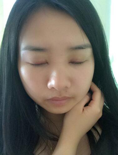 武漢樂美韓式微創(chuàng)雙眼皮+開內眼角