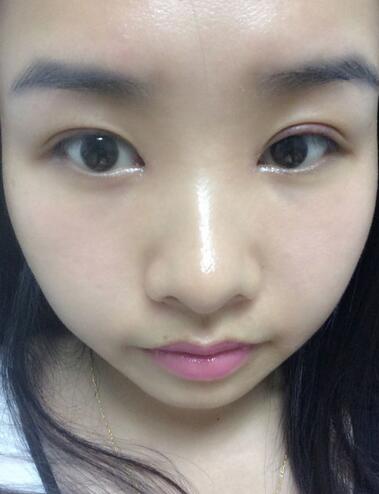 武漢樂美韓式微創(chuàng)雙眼皮+開內眼角