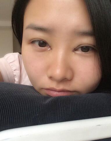 武漢樂美韓式微創(chuàng)雙眼皮+開內眼角