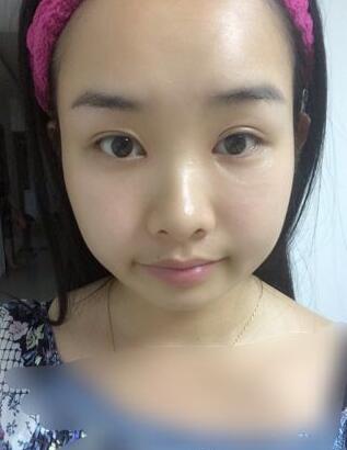 武漢樂美韓式微創(chuàng)雙眼皮+開內眼角