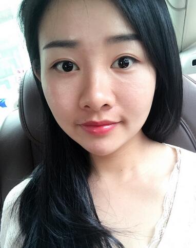 武漢樂美韓式微創(chuàng)雙眼皮+開內眼角