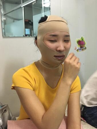 北京八大處張智勇V-line瓜子臉手術(shù)前后對(duì)比