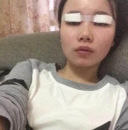 八大處楊明勇做的雙眼皮 半年了