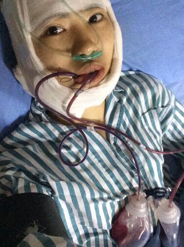 北京八大處下頜角截骨前后果對比