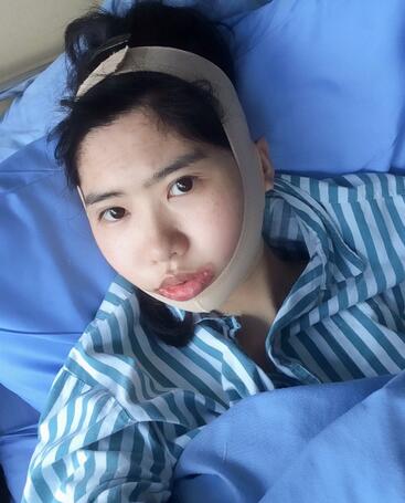 北京八大處下頜角截骨前后果對比