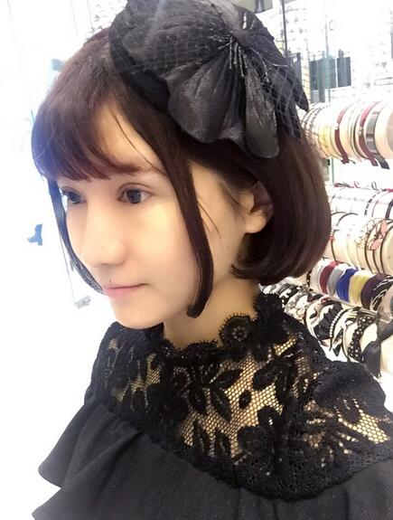 杭州王圣林全切雙眼皮恢復(fù)過(guò)程圖