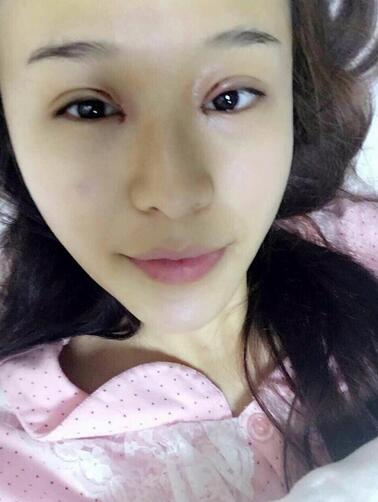 杭州大麥微針龍都整形開眼角+割雙眼皮恢復(fù)記錄