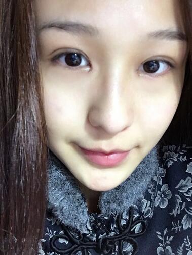 杭州大麥微針龍都整形開眼角+割雙眼皮恢復(fù)記錄