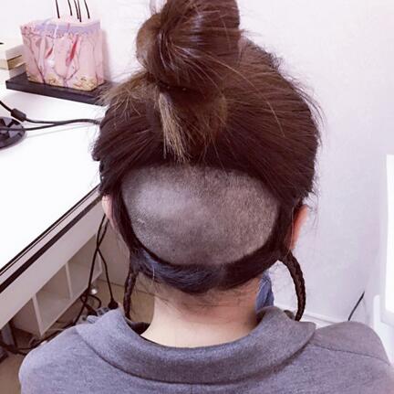 發(fā)際線調(diào)整果對(duì)比圖 杭州大麥微針龍都發(fā)際線種植