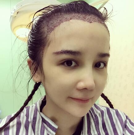 發(fā)際線調(diào)整果對(duì)比圖 杭州大麥微針龍都發(fā)際線種植