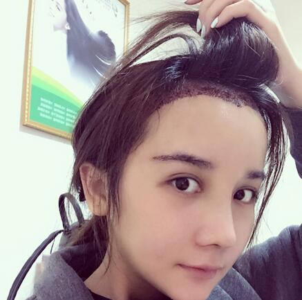 發(fā)際線調(diào)整果對(duì)比圖 杭州大麥微針龍都發(fā)際線種植