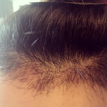 發(fā)際線調(diào)整果對(duì)比圖 杭州大麥微針龍都發(fā)際線種植