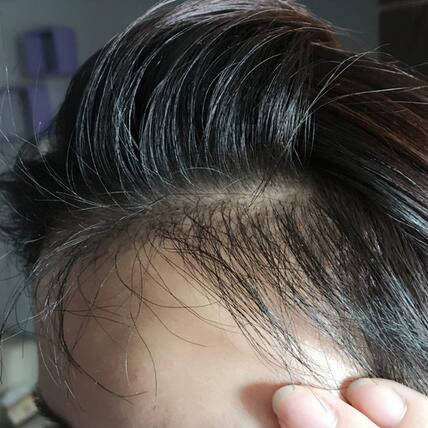 發(fā)際線調(diào)整果對(duì)比圖 杭州大麥微針龍都發(fā)際線種植