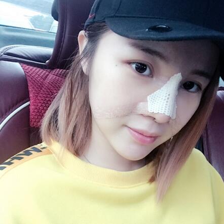 北京八大處李戰(zhàn)強(qiáng)隆鼻案例