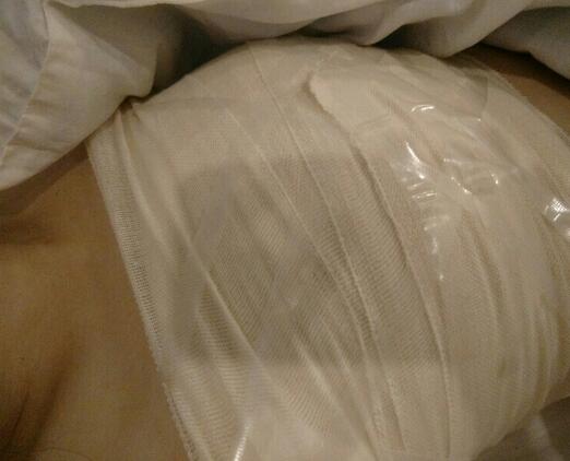 北京八大處穆大力假體隆胸2個(gè)月