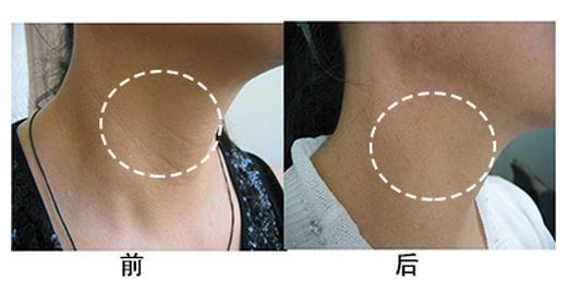 鄭州整形醫(yī)院頸部除皺大概需要多少錢