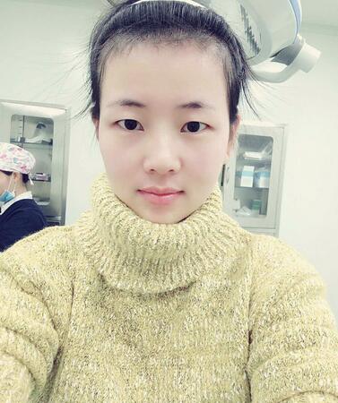 北京八大處辛敏強(qiáng)做雙眼皮怎么樣 案例分享