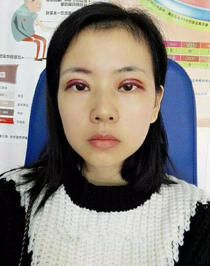 北京八大處辛敏強(qiáng)做雙眼皮怎么樣 案例分享