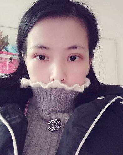 北京八大處辛敏強(qiáng)做雙眼皮怎么樣 案例分享