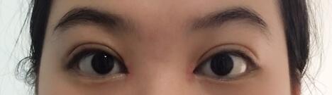 韓式微創(chuàng)雙眼皮恢復圖 深圳妍熙雙眼皮半年