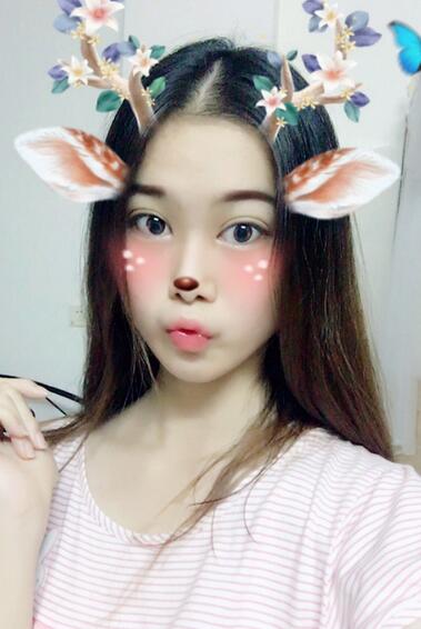 韓式微創(chuàng)雙眼皮恢復圖 深圳妍熙雙眼皮半年