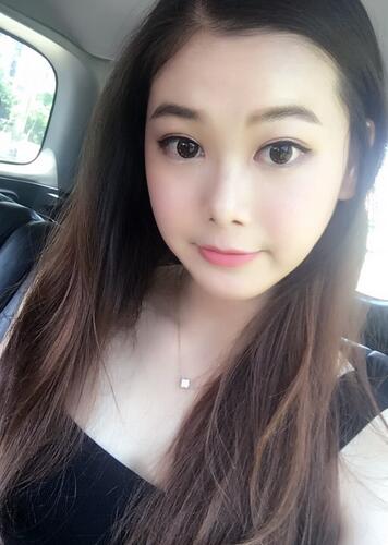 韓式微創(chuàng)雙眼皮恢復圖 深圳妍熙雙眼皮半年